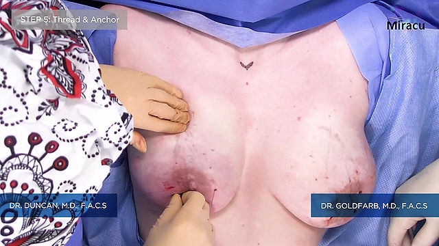 Breast Lift - Dr.Duncan